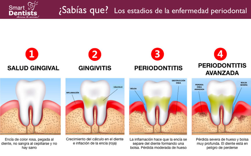 estados de enfermedades periodontal