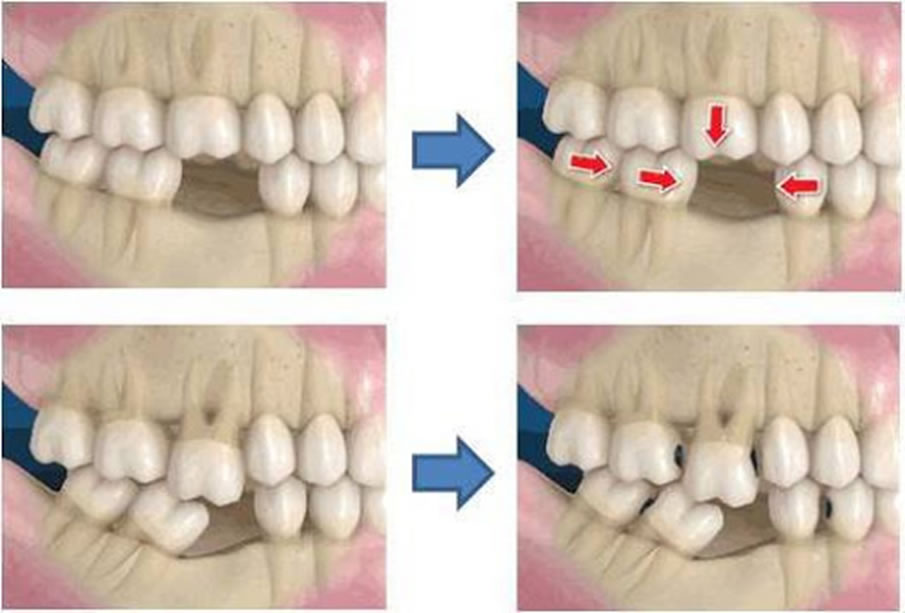 consecuencias-de-implantes-dentales-1