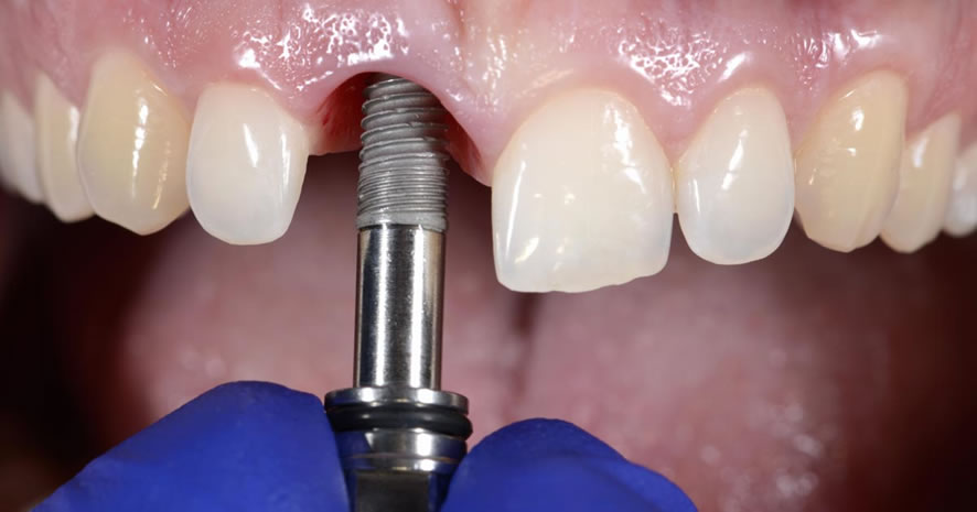 consecuencias-de-implantes-dentales-colocacion-de-implantes-dentales