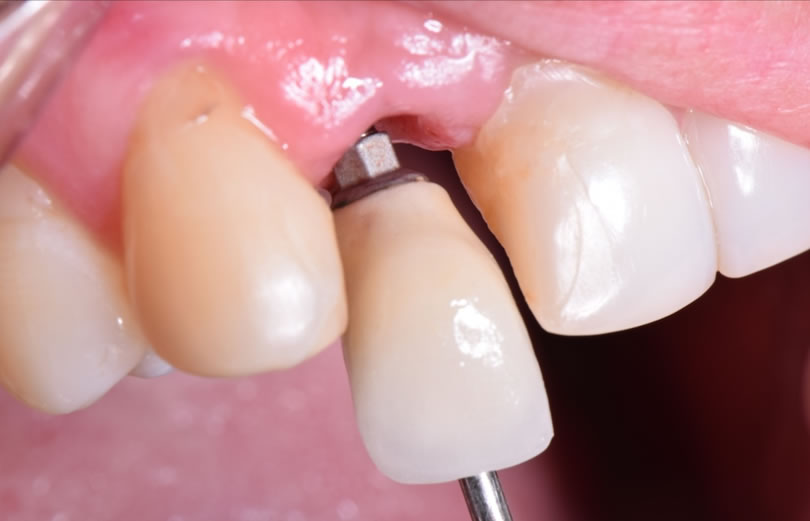 consecuencias-de-implantes-dentales-colocacion-de-implantes-dentales2