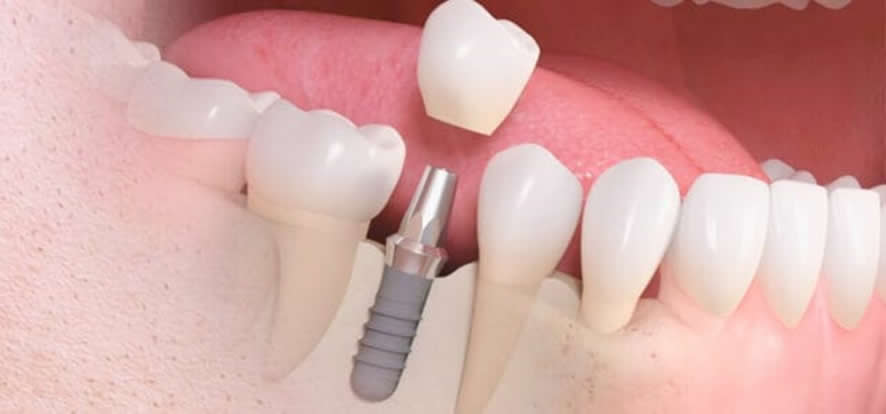 Ventajas de los implantes Dentales