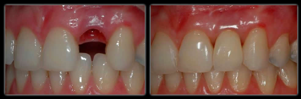 caso de implante dental guayaquil