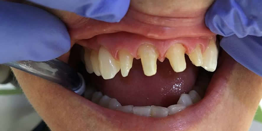 tallado de dientes para implantes