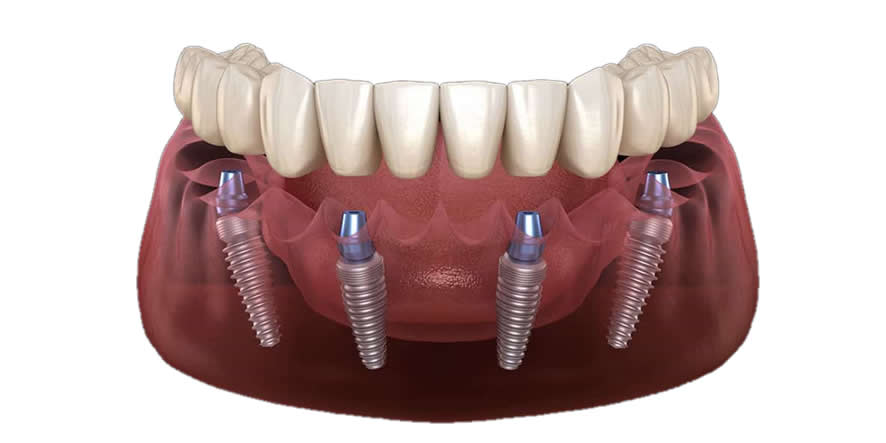 Protesis de implantes totales