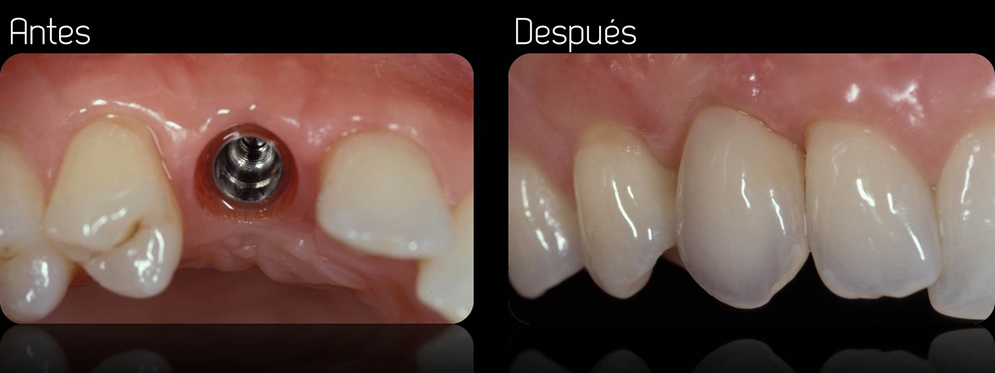 implantes-dentales-guayaquil-samborondon-sauces-smart-dentists