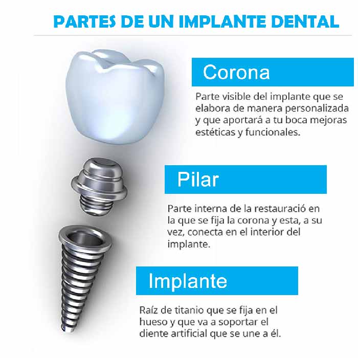 ¿Te pondrán un implante dental?【Conoce todo lo que debes saber】