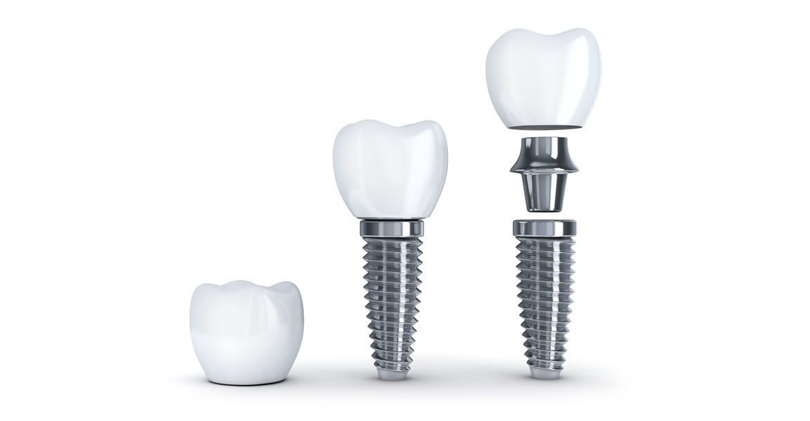 implantes-dentales-blog-1