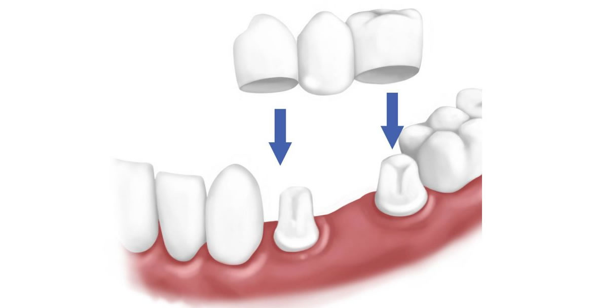 puente-dental-blog-1