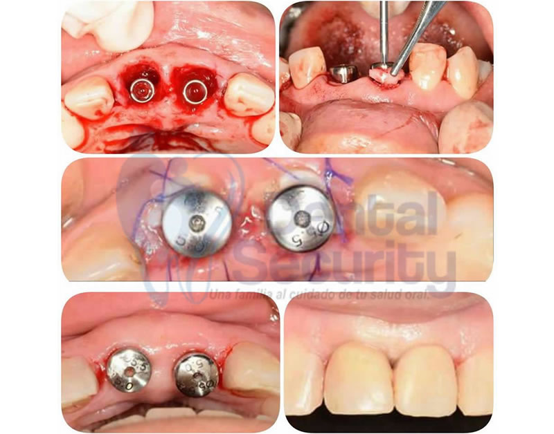 cirugia-implantes