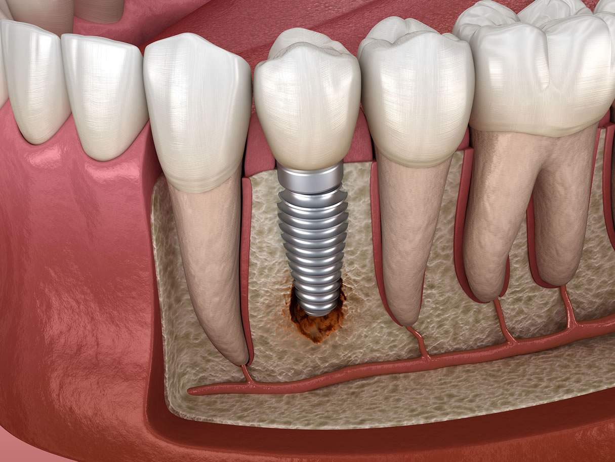 complicacion-dental