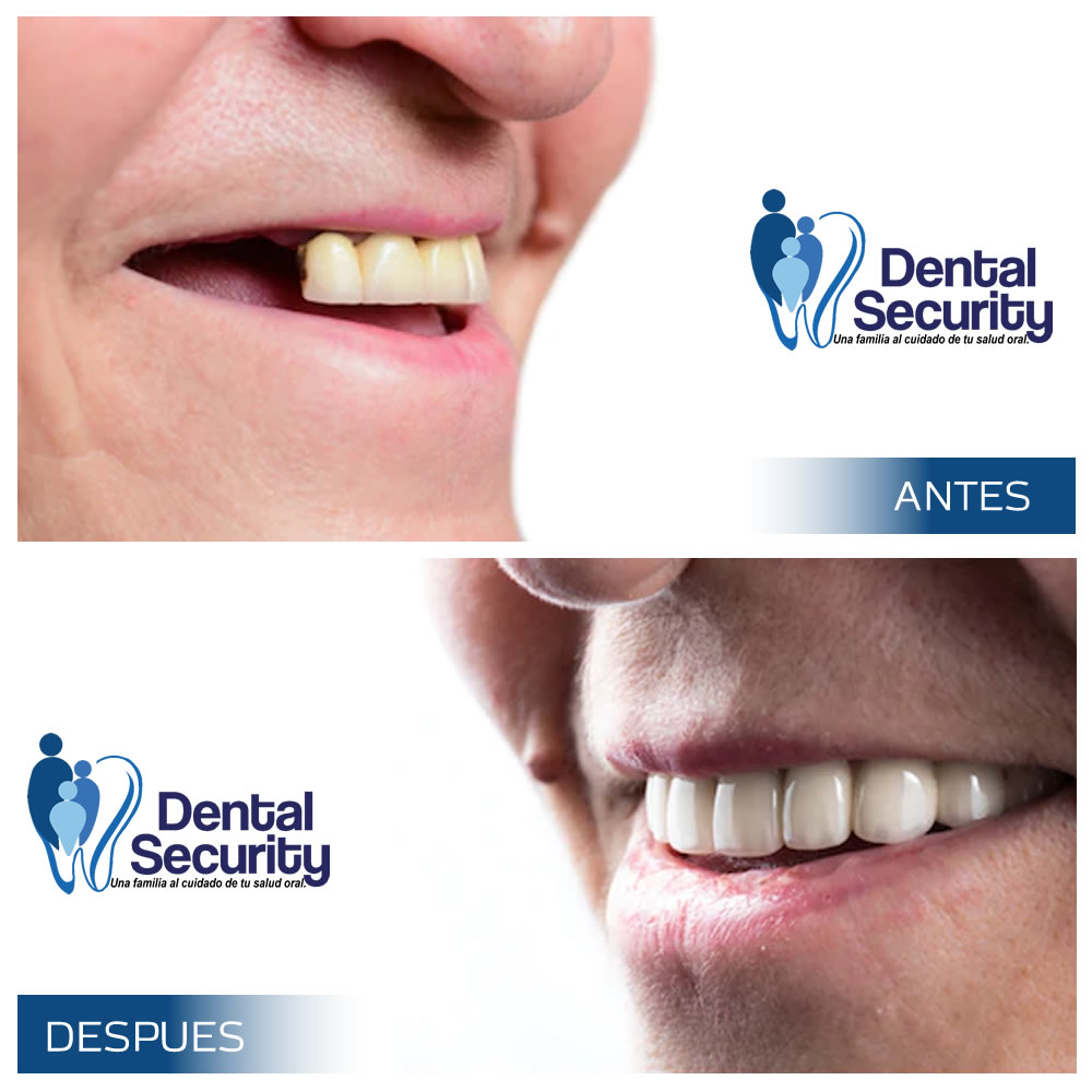 implantes-dentales-security-odontologosenlaweb