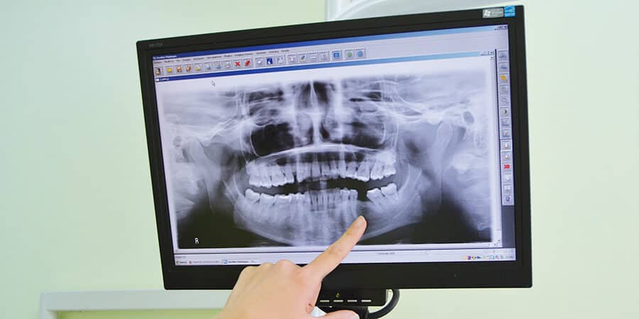 radiografia-falta-de-dientes