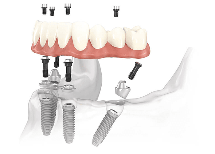 full-denta-inferior (2)