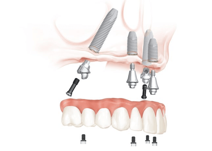 full-denta-superior (2)