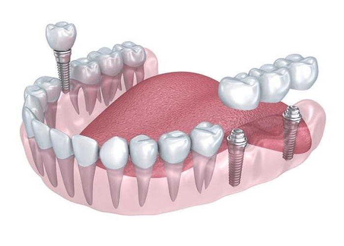 implant-multiple (2)