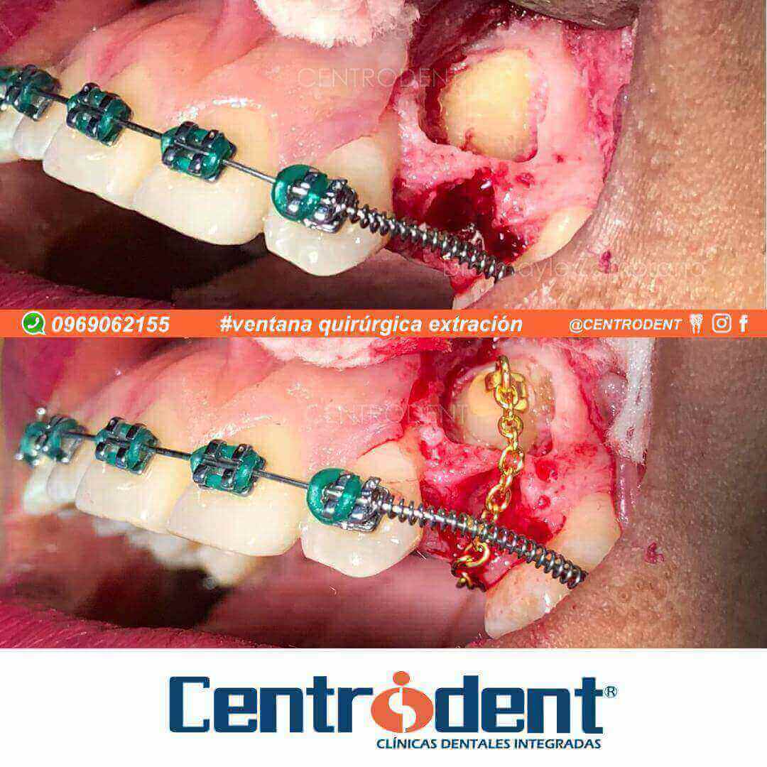 Caso de Ventana quirúrgica  por extracción 👨‍⚕ CENTRODENT