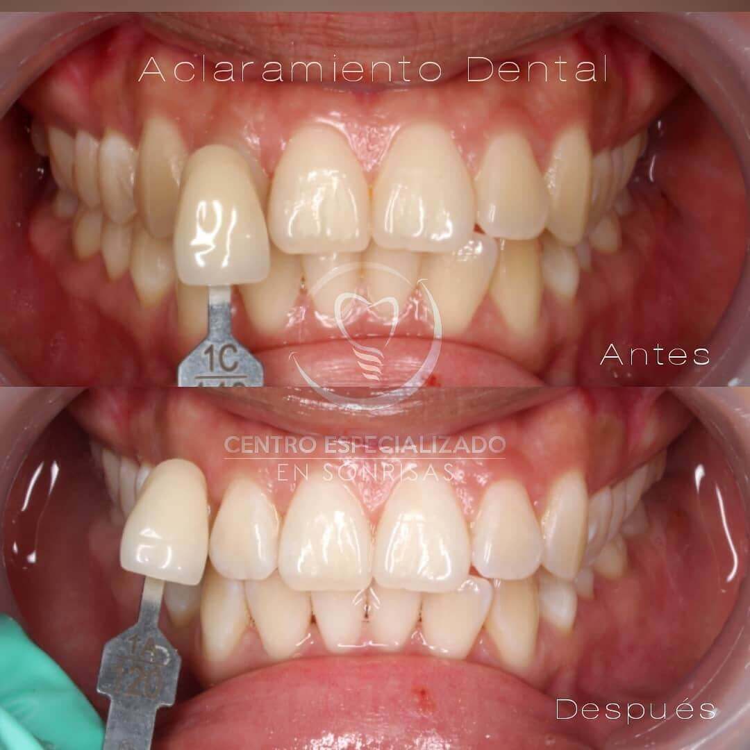 En este caso se realizó limpieza y 1 sesión de aclaramiento dental 😁