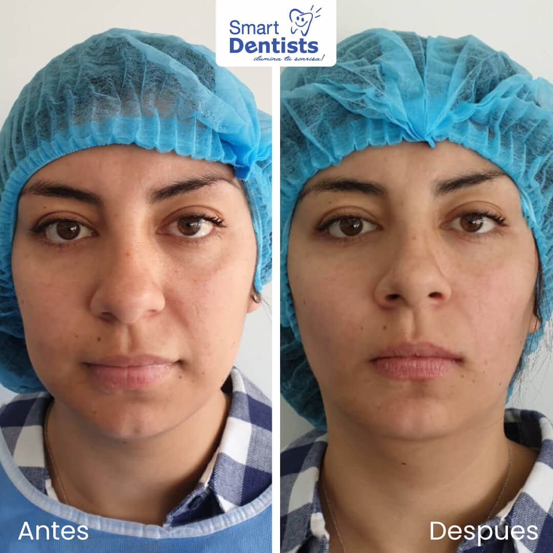 Se realizo una Bichectomia, claramentetenemos un antes y despues. 