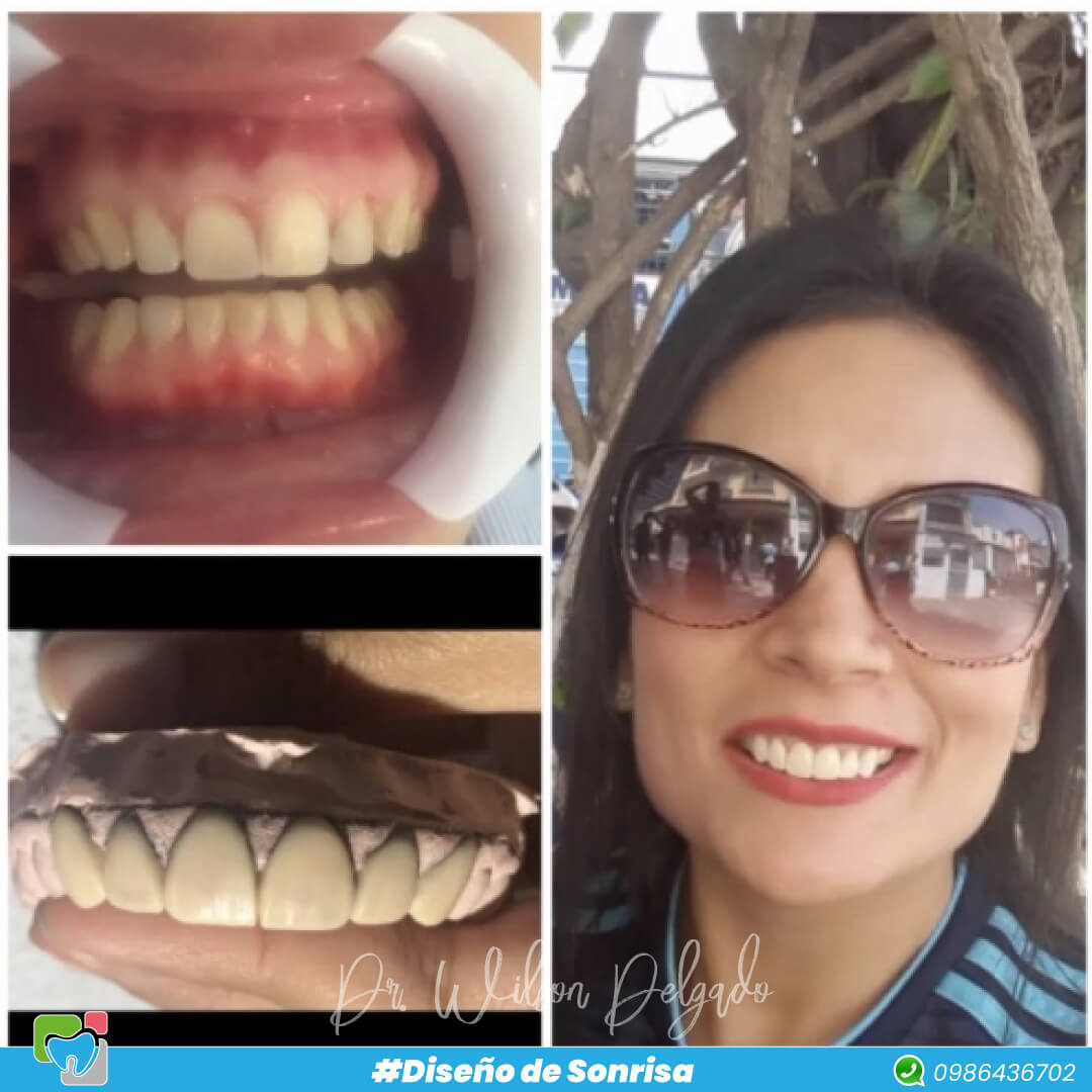 Inicia tu año con una Hermosa Sonrisa  😁 Carillas Dentales