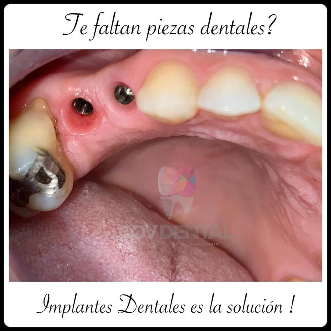 Te hacen falta piezas dentales?