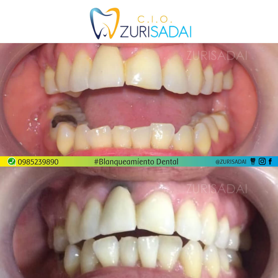 🤩blanqueamiento dental🤩