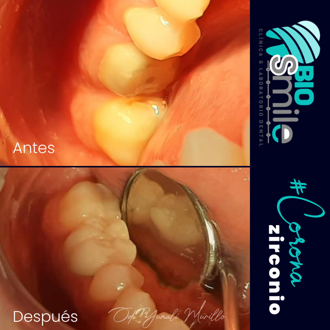 Devolviendo la funcion masticatoria y estética a nuestro paciente.