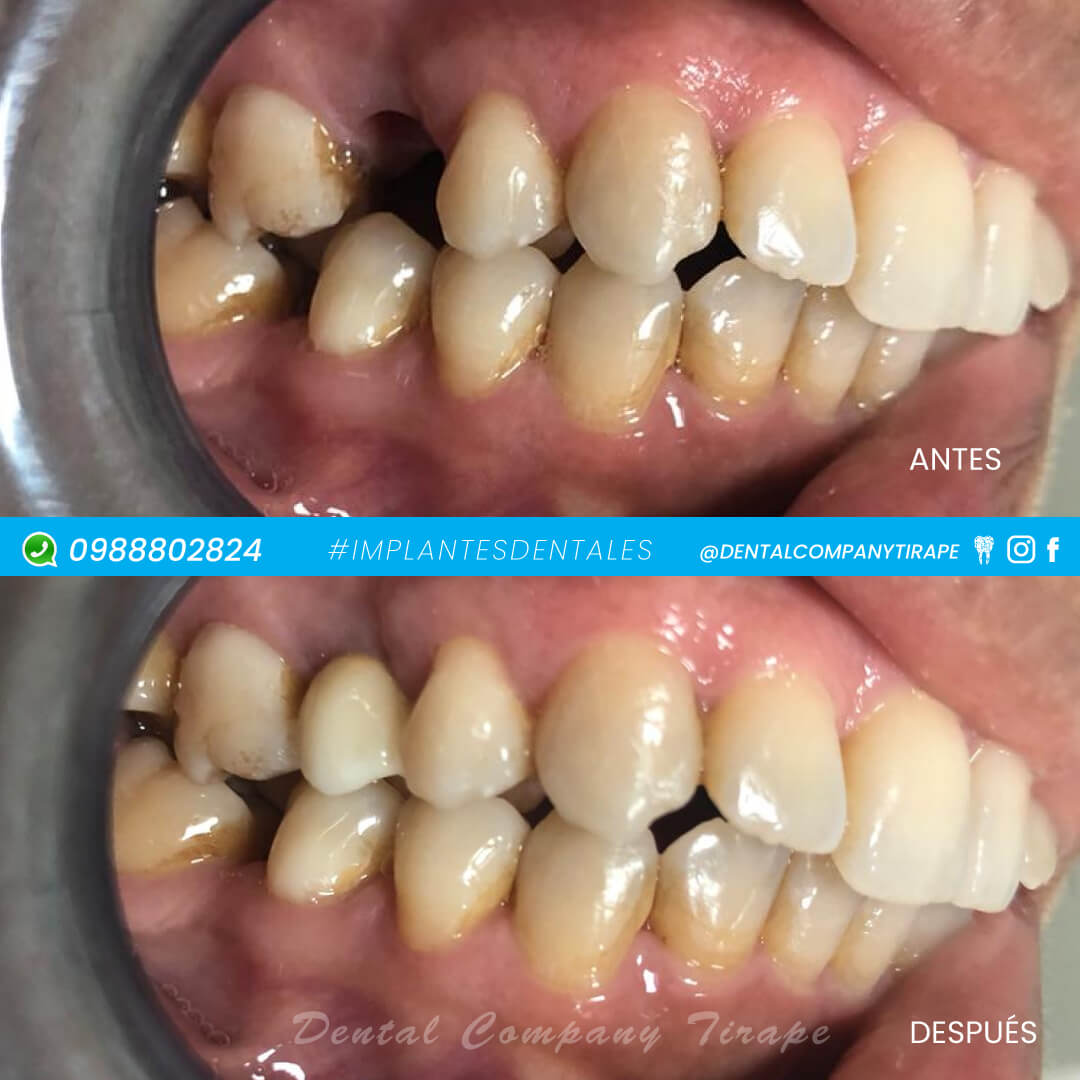 HOY MOSTRAMOS UN EXCELENTE RESULTADO DE IMPLANTES DENTALES