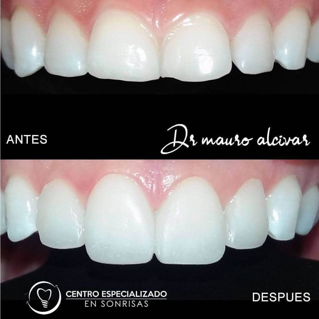 Cuéntanos qué es lo que no te gusta de tus dientes?