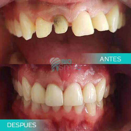 DISEÑO DE SONRISA | Perfeccionamos tu Sonrisa