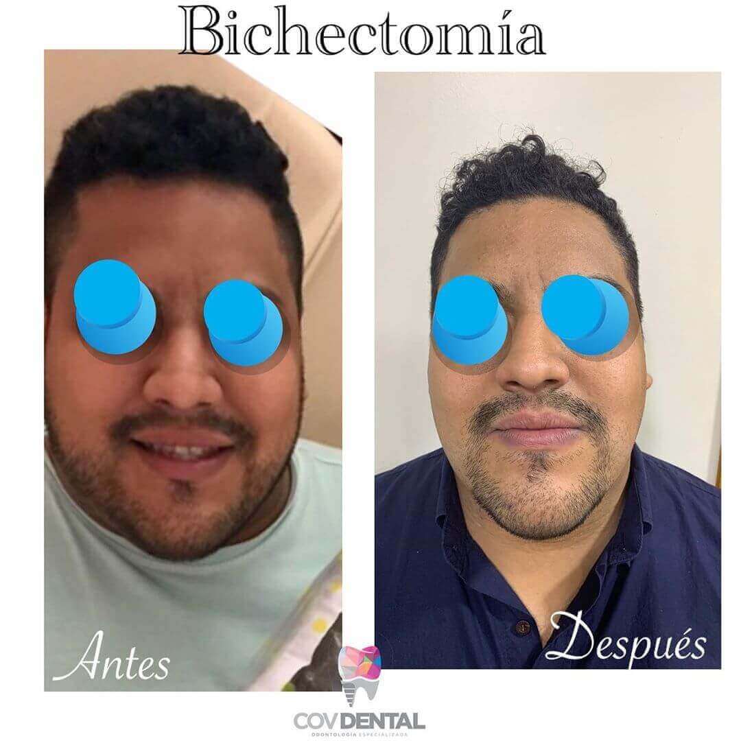 Estiliza tu rostro, mediante Bichectomía.