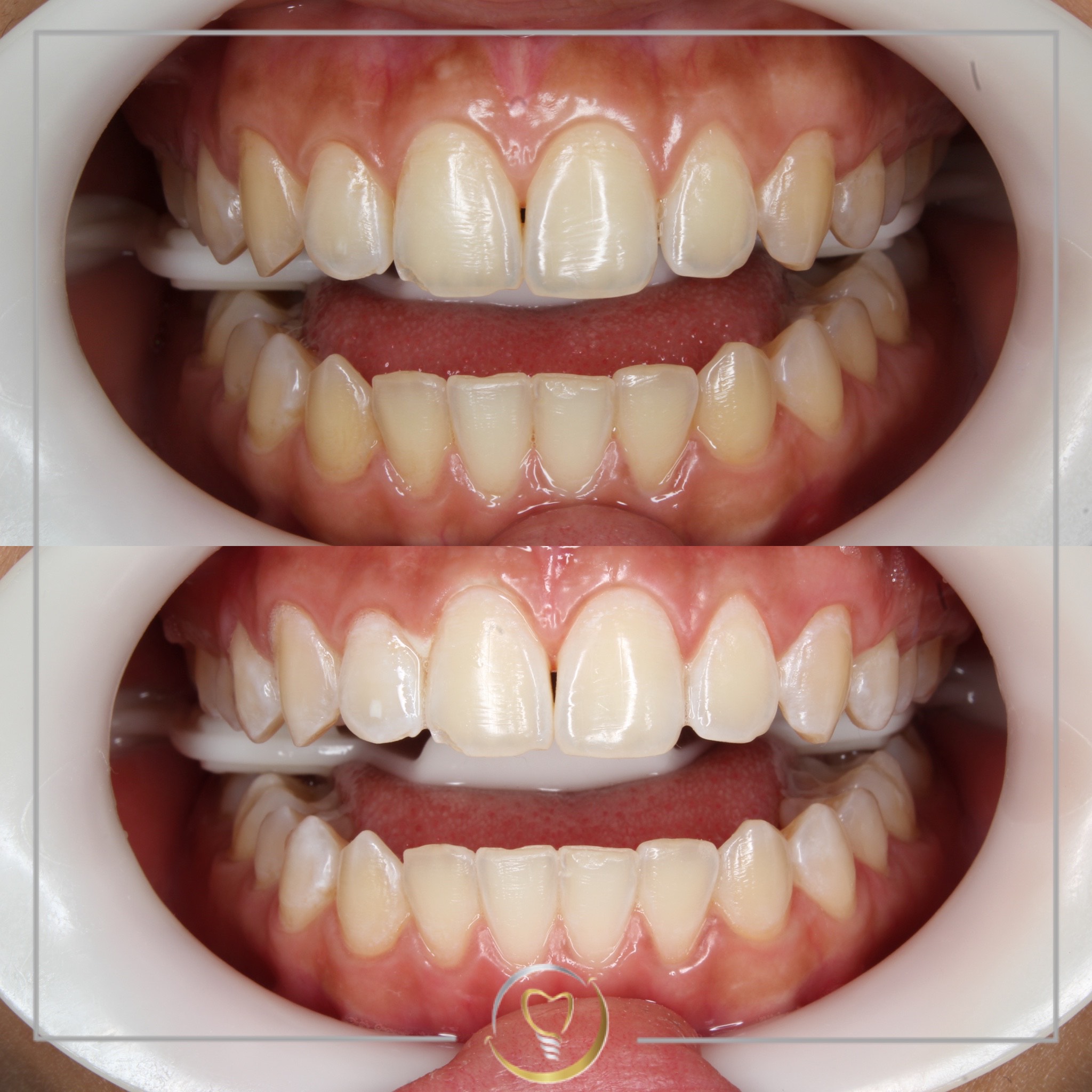 Blanqueamiento o Aclaramiento dental