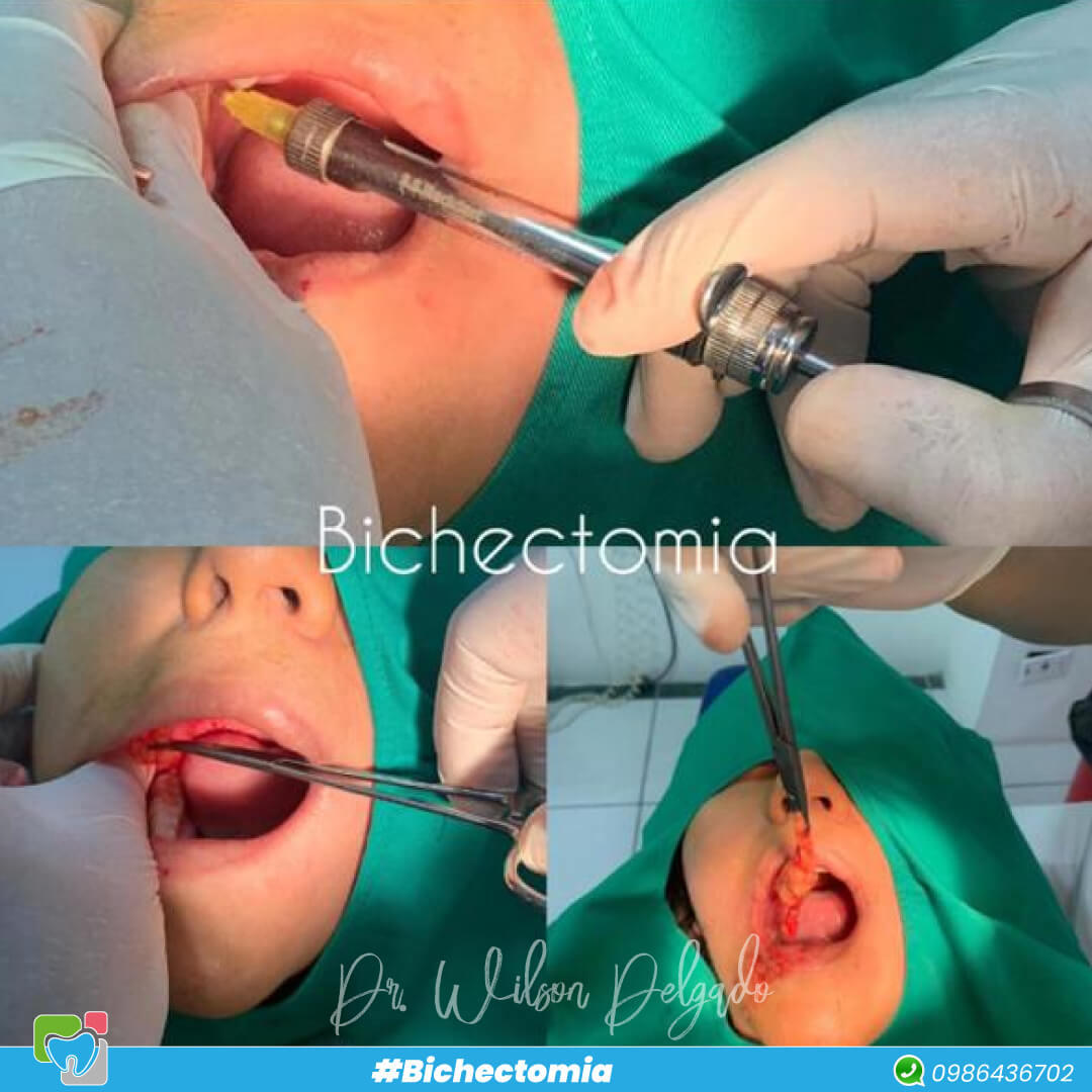 Reducción de Mejillas (Bichectomia) 