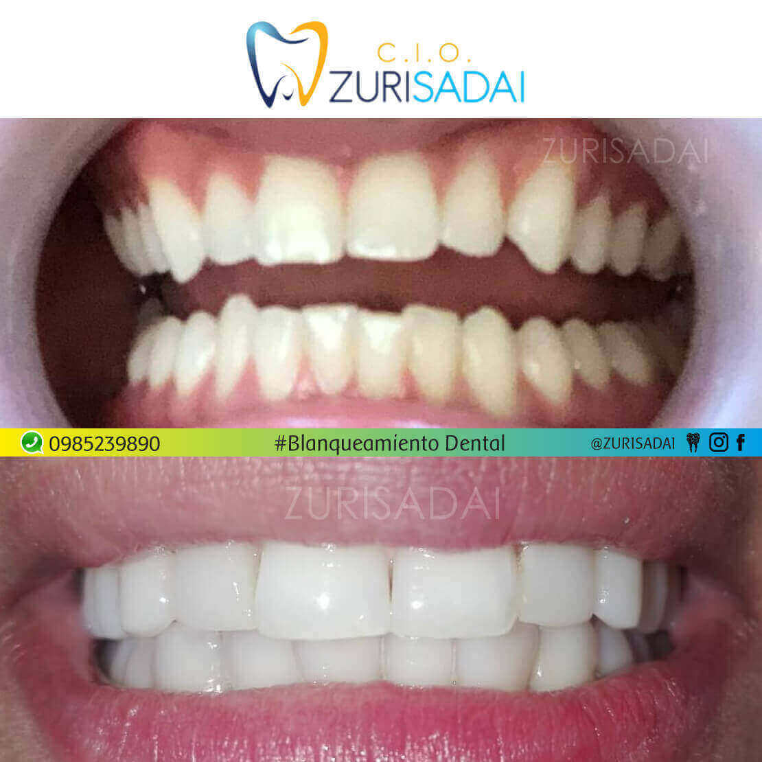 Excelente resultado de blanqueamiento dental. 🤩🤩