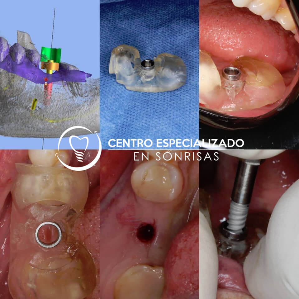 Los implantes dentales en nuestra clínica son planificados digitalmente, y con impresora 3D