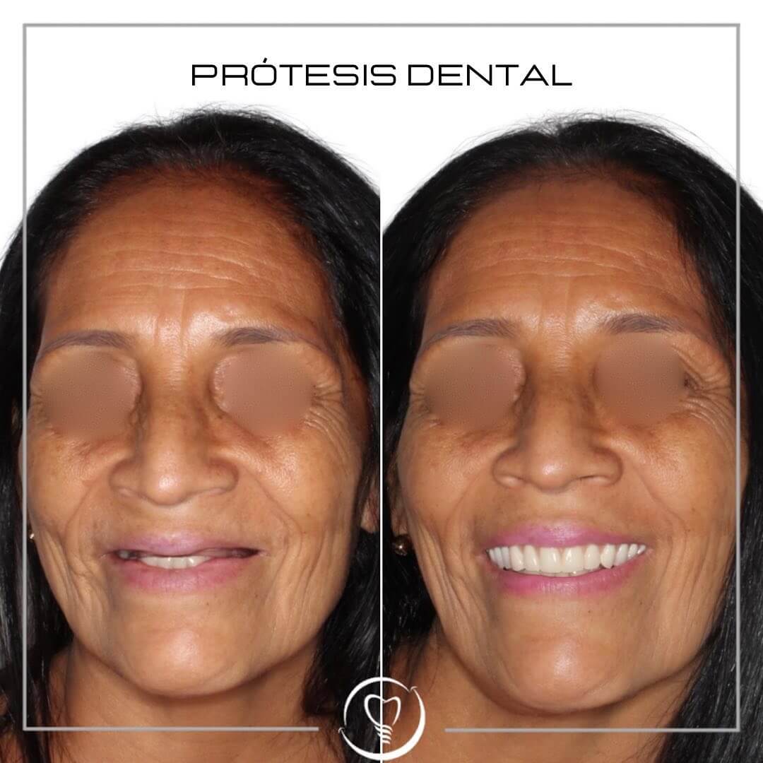 Devolviendo sonrisas 😁 Pprotesis Removible de alta estética,