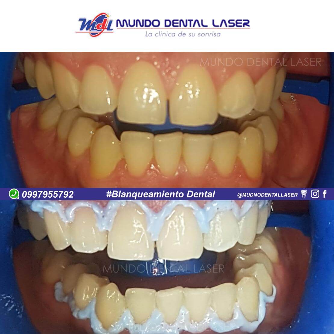 Blanqueamiento Dental | Cambios que solo puedes encontrar en Mundo Dental Laser