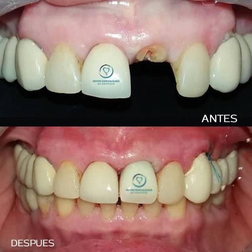 Te falta un diente? 🙊Obtén una Sonrisa segura con Implantes Dentales