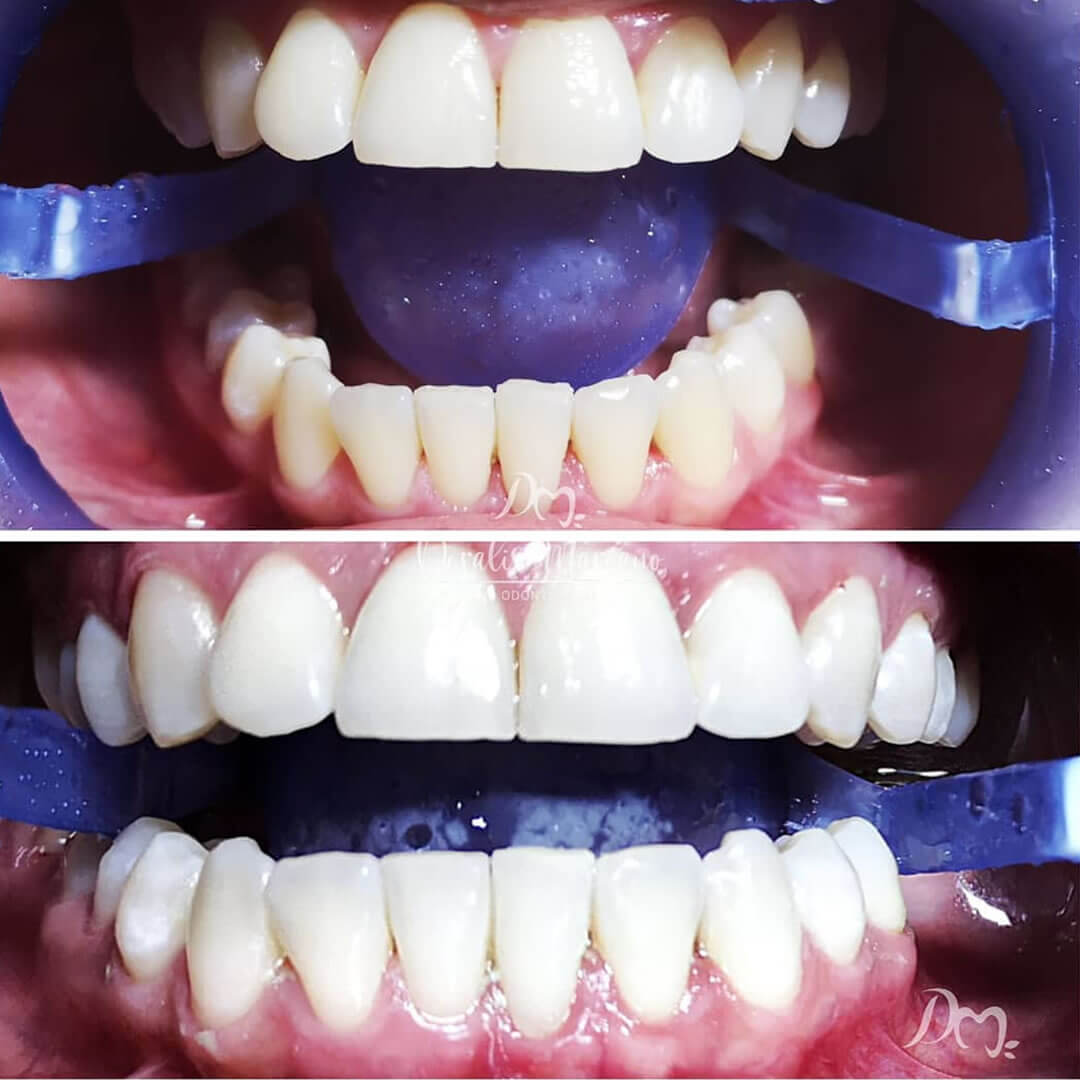 ¿El color de tus piezas dentales está opaca y sin brillo? 