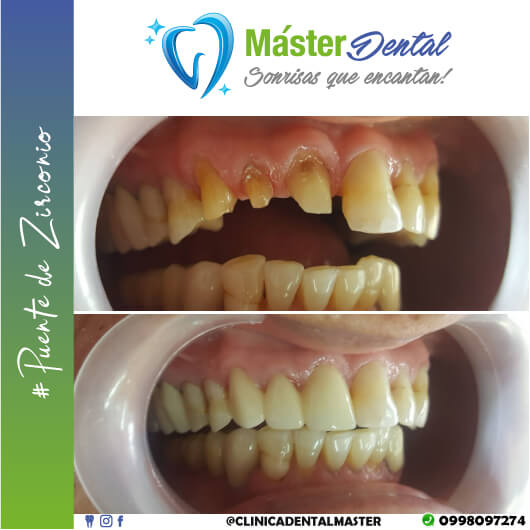 PUENTE DE ZIRZONIO | MÁSTER DENTAL TÚ MEJOR SONRISA 😁