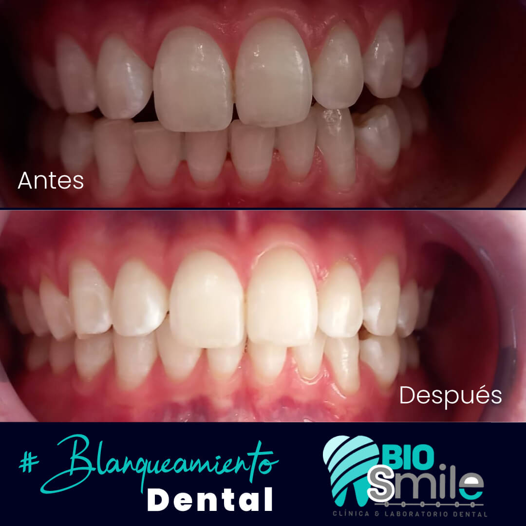 En Biosmile ✨ puedes recuperar la confianza de sonreír con nuestro blanqueamiento dental