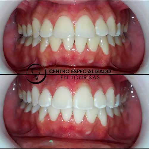 BLANQUEAMIENTO Dental