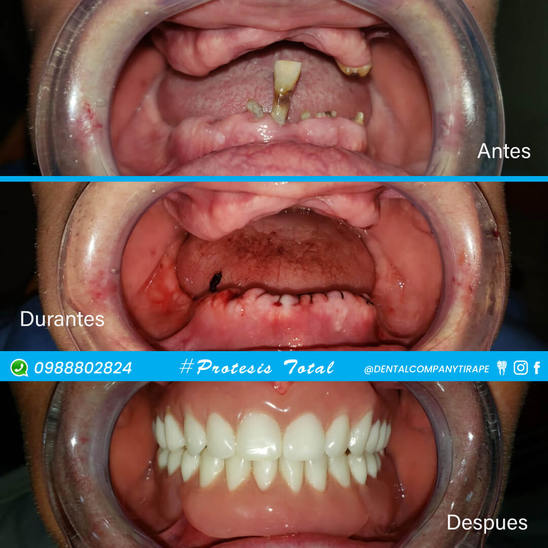 Protesis Dental Total 👉 Dental Company Tirape