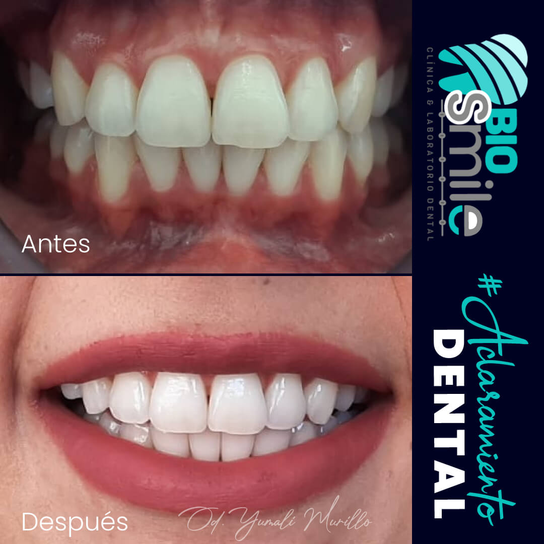 Blanqueamiento Dental | Cambios que solo puedes encontrar en Biosmile Clinica dental