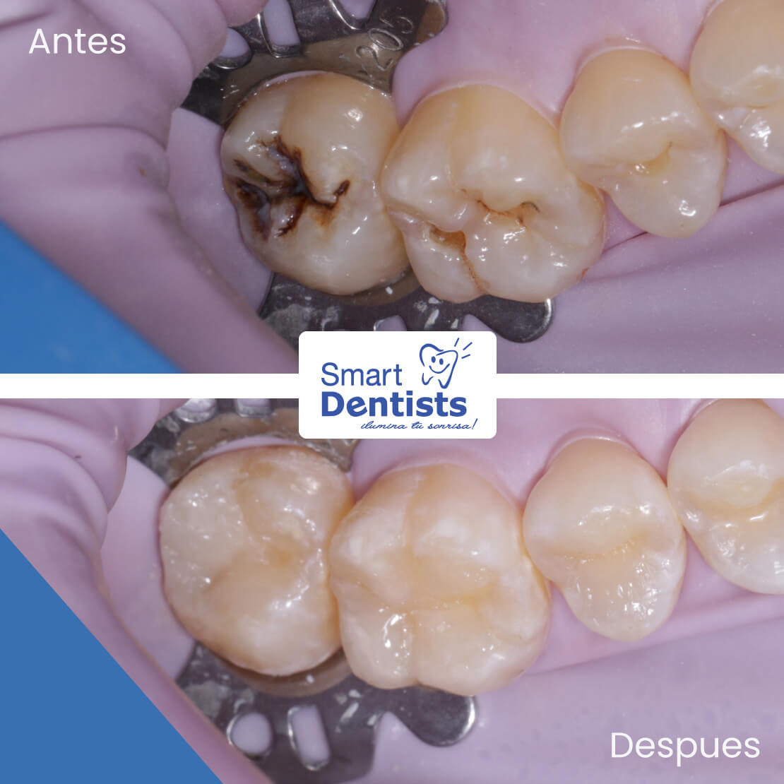 Tratamiento con carillas dentales. Tu nueva sonrisa en 15 días. - Clínica  Dental CIMER Paterna