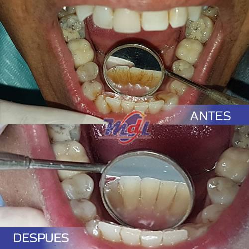 Limpieza Dental Profunda No esperes a tener malestares