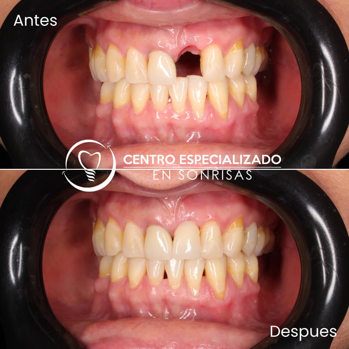 TE FALTA UN DIENTE? 🙊OBTÉN UNA SONRISA SEGURA CON IMPLANTES DENTALES