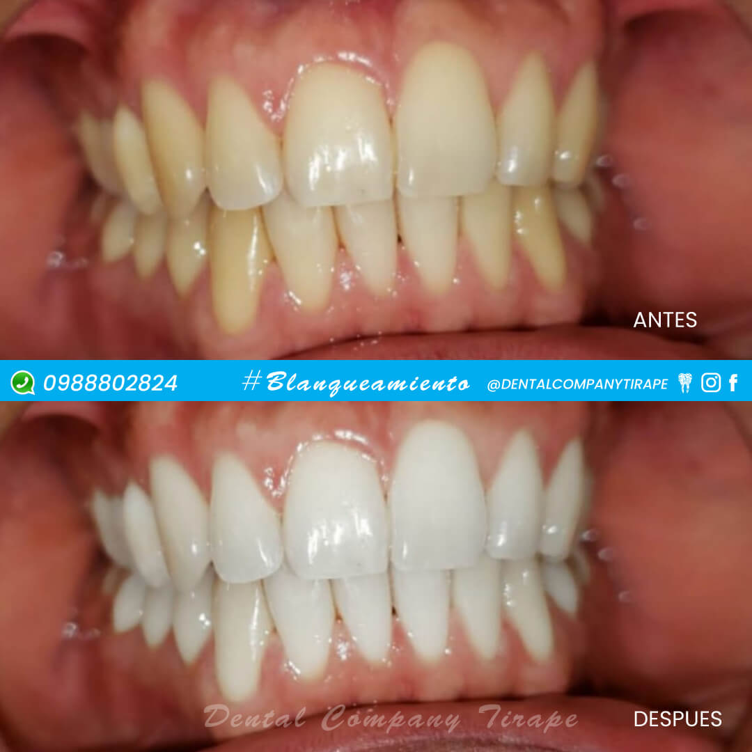 🤩En Dental Company queremos ver tu sonrisa brillar por eso te ofrecemos Blanqueamiento Dental