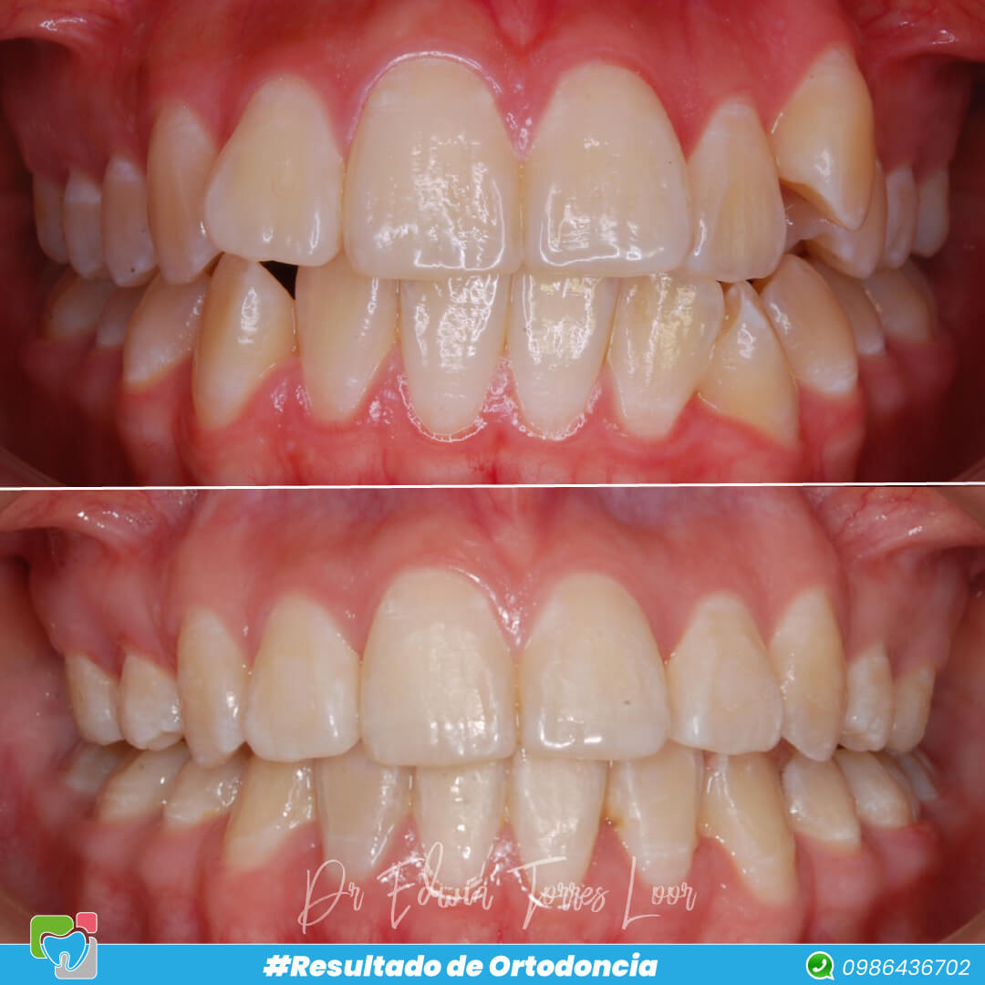 RESUTALDO DE ORTODONCIA ✅ EN MANOS DE UN ESPECIALISTA