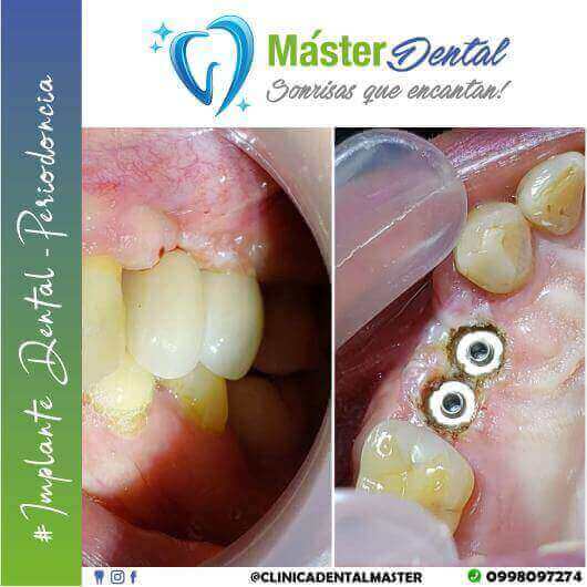 Obtén una sonrisa segura con Implantes Dentales ✅ 