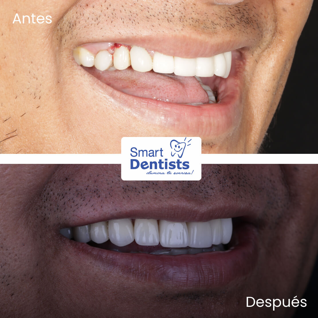 Implantes Dentales 👌🏼⠀y Diseño de Sonrisa